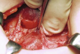 Fig. 60.3, Pathologic glands in a 13-year-old patient with secondary HPT. Initially, the inferior gland is inferiorly descended and hidden by the pretracheal fascia from where it can be pulled up.