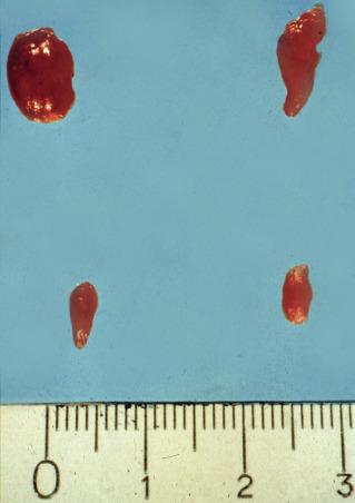 Fig. 60.4, Parathyroid glands in patient with borderline hypercalcemia and hyperplasia with minimal glandular enlargement (autopsy case) (ruler in centimeters).