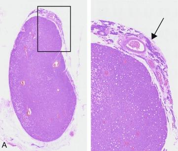 Fig. 60.5, Distinguishing a chief cell parathyroid adenoma ( A ), with a clear rim of compressed normal parathyroid ( A , right panel, arrow ), from a nodular hyperplastic gland ( B ), with multiple separate hyperplastic nodules ( B , right panel, arrows), is usually straightforward. Tumor ( A ) weighed 2110 mg and was excised from a 66-year-old male patient with PHPT. A single enlarged parathyroid was seen on MIBI and USS. Tumor ( B ) was one of four enlarged parathyroids seen at surgery in a 63-year-old female patient with PHPT. She was successfully treated with a subtotal parathyroidectomy. Panel ( C ) shows a 780 mg tumor removed from a 30-year old female patient with renal stones and a single enlarged gland on MIBI and USS. Although it is composed predominantly of chief cells, there is some nodularity ( C , right panel , arrows ) with scattered oxyphil cells, and no compressed rim of normal parathyroid tissue. Such appearances may be compatible with an adenoma if the other three glands are normal. However, those glands were not seen at surgery because a focused parathyroidectomy was performed. This exemplifies the difficulty with which pathologists are often faced, particularly if operative information is limited. All three patients were normocalcemic on review ≥ 6 months after surgery.