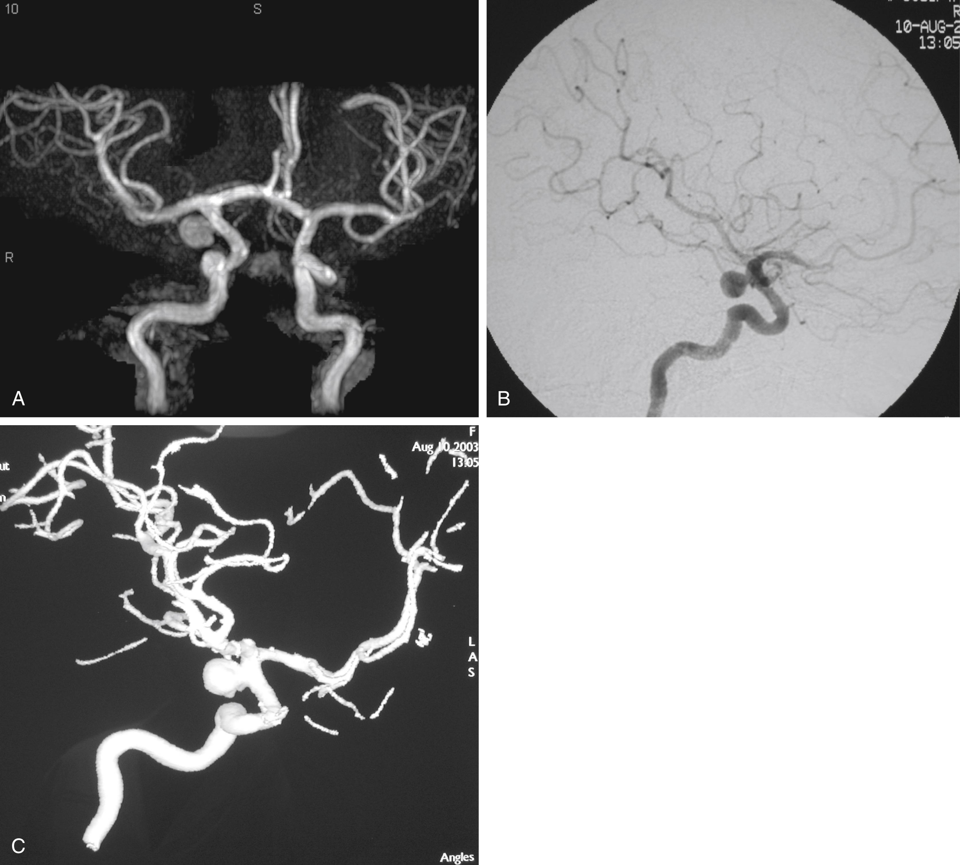 FIGURE 47.1, Magnetic resonance angiography (A), digital subtraction angiography (B), and three-dimensional angiography (C) views of a right posterior communicating artery–region aneurysm.