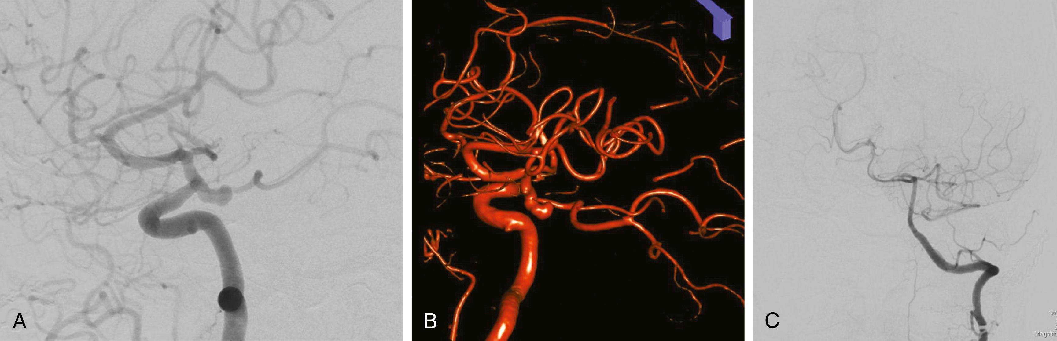 FIGURE 47.2, Lateral left internal carotid artery digital subtraction angiography (DSA) (A) and three-dimensional DSA (B) of a posterior communicating artery–region aneurysm with a fetal posterior cerebral artery (PCA). Anterior-posterior view of a left vertebral artery DSA (C) in the same patient, with absence of a left PCA visualization, indicative of a fetal PCA configuration.