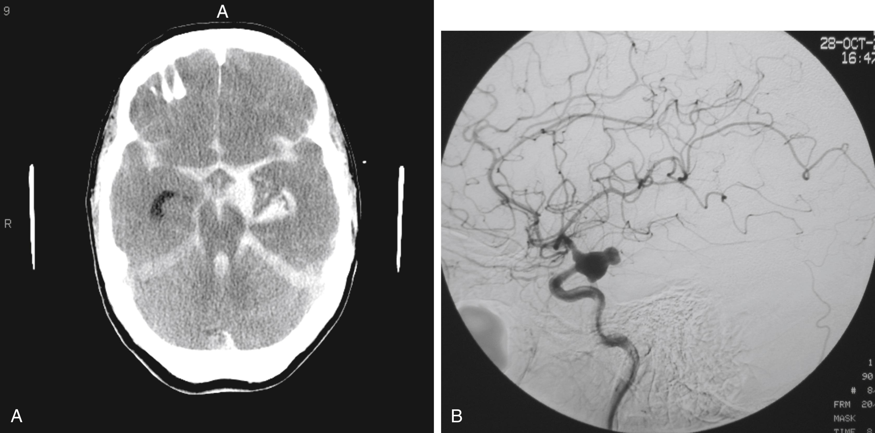 FIGURE 47.3, (A) Head computed tomography with a diffuse subarachnoid hemorrhage, particularly in the left-sided basal cisterns, suspicious for a ruptured internal carotid artery (ICA) aneurysm. (B) Lateral view of a digital subtraction angiography of a left ICA injection showing a large, multilobulated posterior communicating artery aneurysm.