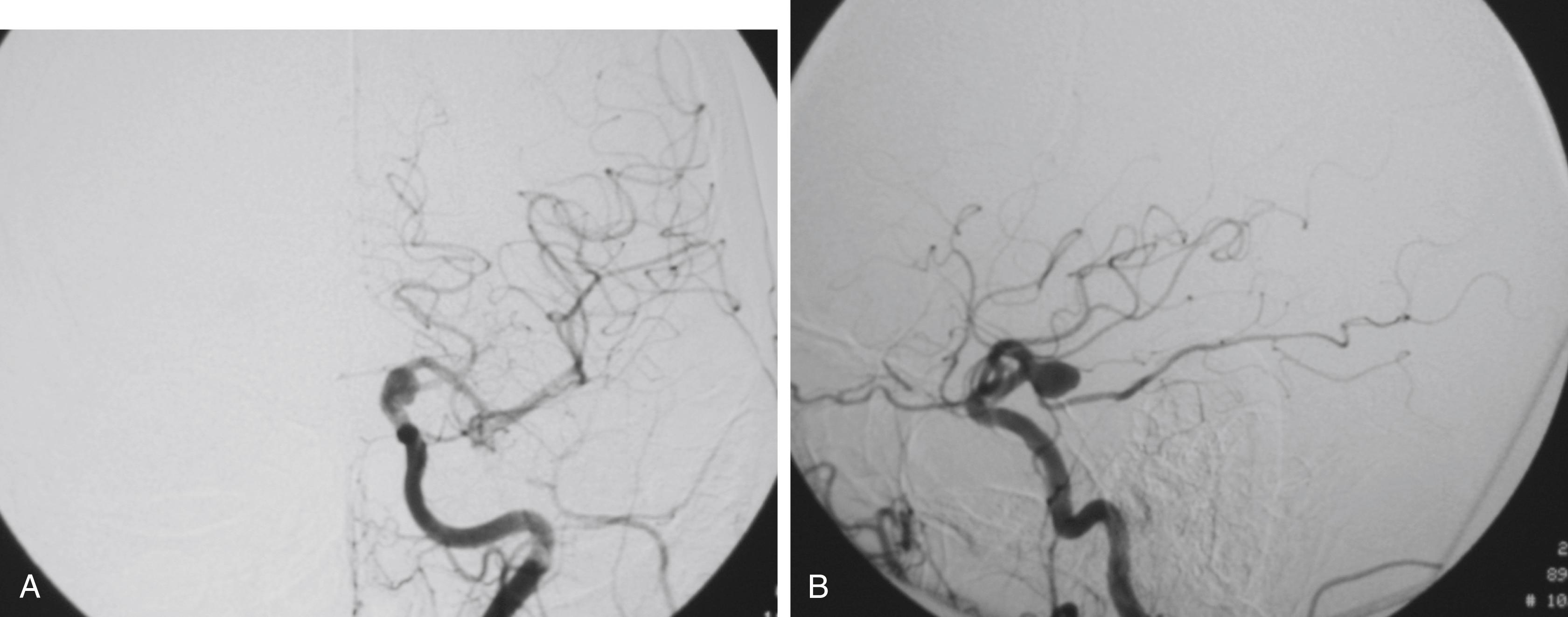 FIGURE 47.4, Left internal carotid artery injection on a digital subtraction angiography with an anterior choroidal artery aneurysm: anterior-posterior (A) and lateral (B) views.