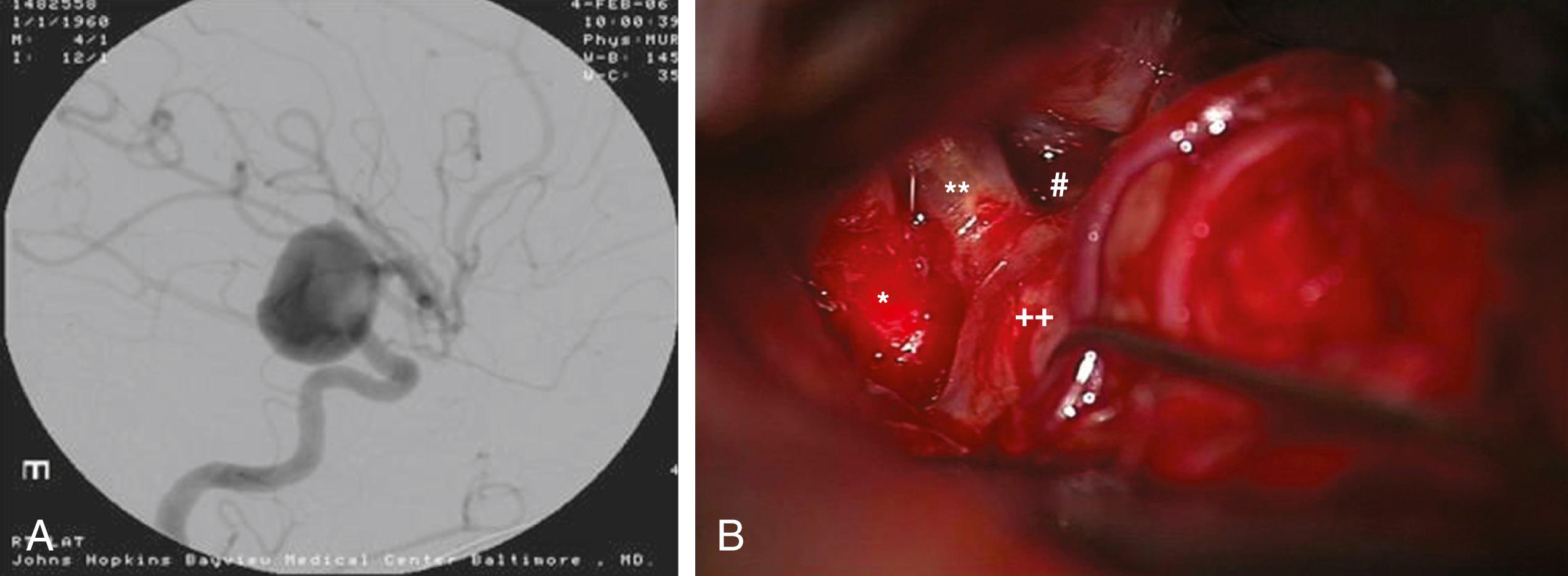 FIGURE 47.5, (A) Lateral digital subtraction angiography of a right posterior communicating artery (PComA) aneurysm. (B) Intraoperative view showing the optic nerve (∗), supraclinoid internal carotid artery (∗∗), PComA (#), and neck of the laterally projecting aneurysm (++).