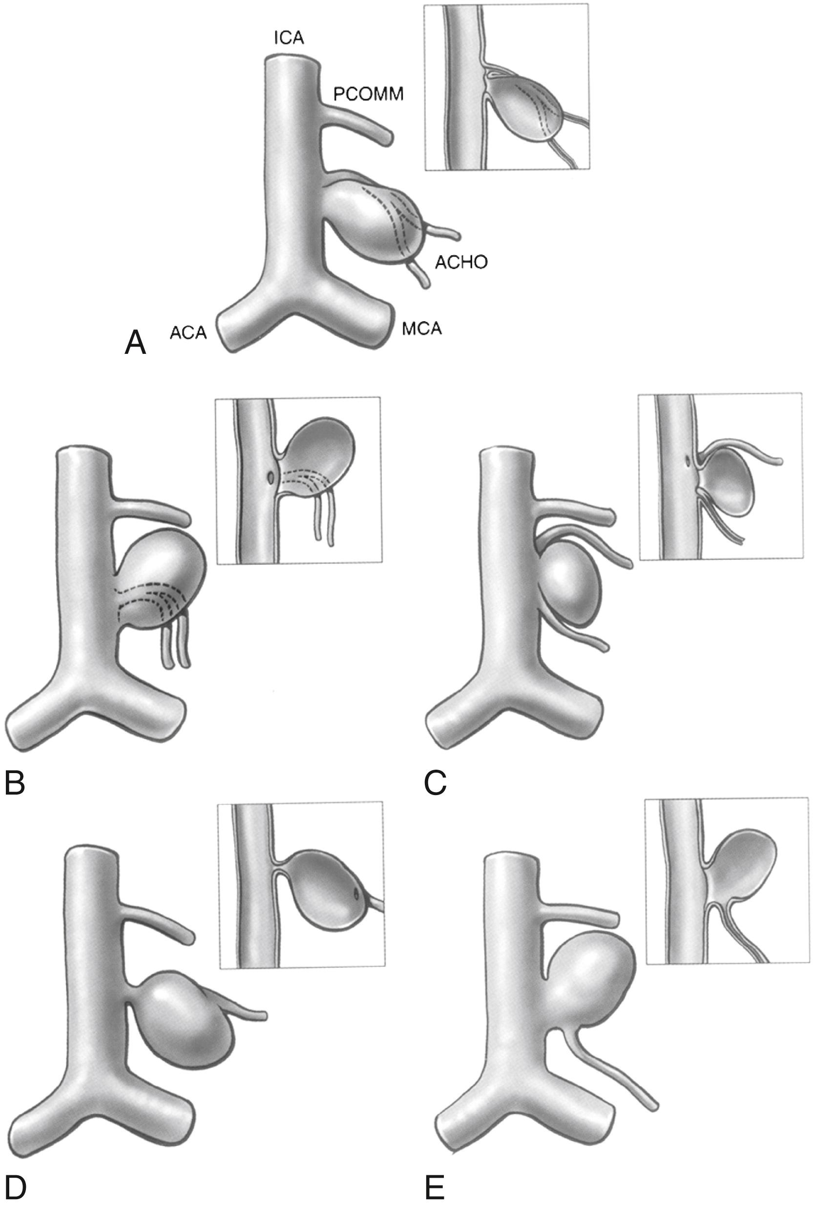 FIGURE 47.6, Schematic illustration of anterior choroidal artery (AChA) arising from the proximal neck region of an AChA aneurysm (A) and various other configurations of branch artery origins (B–E). ACA , Anterior cerebral artery; ACHO, anterior choroidal artery; ICA , internal carotid artery; MCA , middle cerebral artery; PCOMM, posterior communicating artery.