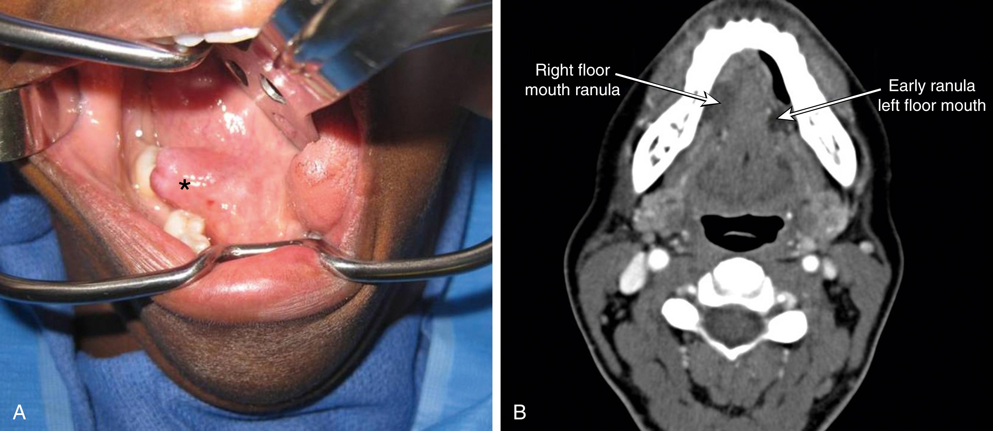 Fig. 89.1, A, Bilateral floor of mouth ranula; the asterix showing a prominent floor of mouth ranula. B, Computed tomography scan (axial view) showing bilateral floor mouth ranulas.