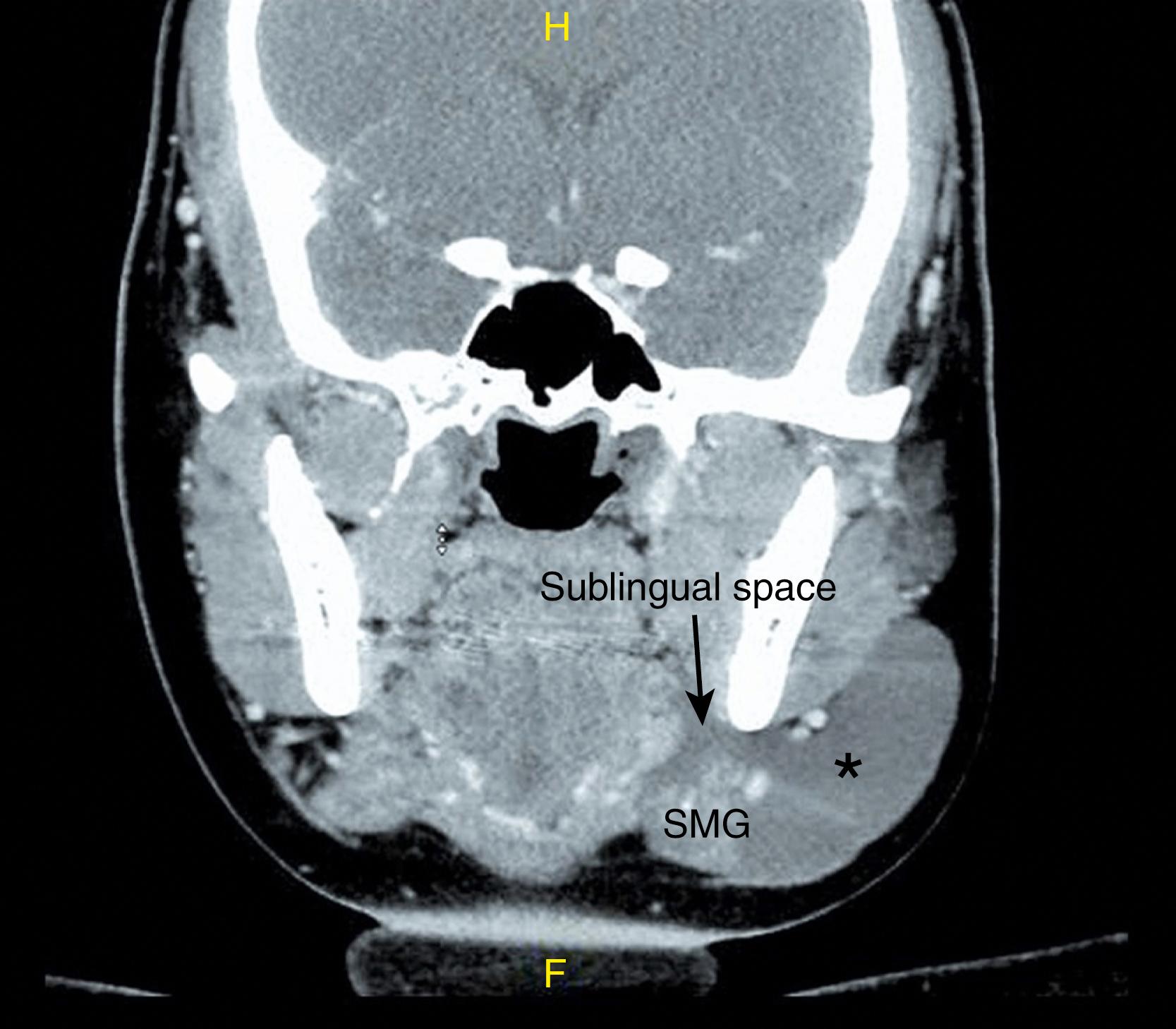 Fig. 89.2, Computed tomography scan (coronal view) showing ranula involving sublingual space and expanding beyond the mylohyoid sling into the upper neck spaces. The arrow points to the sublingual space. SMG indicates the location of the submandibular gland being displaced by the plunging component of the ranula (indicated by asterix).