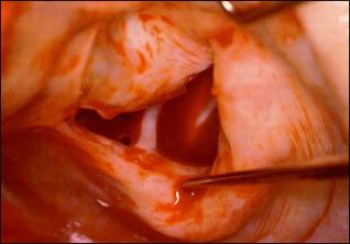 Fig. 8.1, Intraoperative view of a rheumatic mitral valve with a “fish-mouth” appearance resulting from severe generalized thickening of both leaflets and fusion of the commissures.