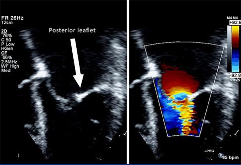 Fig. 8.3, Echocardiogram: Two-chamber view of mitral valve with severe regurgitation and stenosis. Note posterior leaflet thickening and restricted movement in diastole.