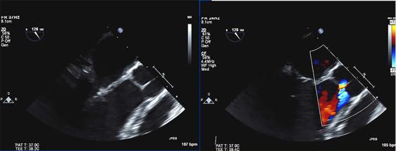Fig. 8.4, Moderate aortic regurgitation due to single leaflet prolapse, repairable.