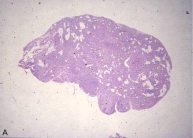 Fig. 61.4, A, Diffuse hyperplasia. Parathyroid parenchymal cells, mainly chief cells proliferate diffusely with lobular structure. B, Nodular hyperplasia. In nodular hyperplasic gland that contains well circumscribed encapsulated nodules, each nodule usually consisting of a single cell type.