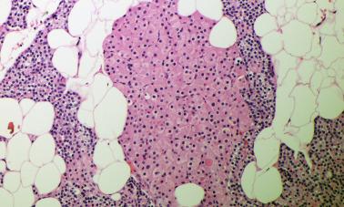 Fig. 65.2, Normal parathyroid gland from a middle-aged adult containing small oncocytic nodules. The oncocytes have abundant eosinophilic cytoplasm.