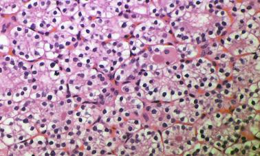 Fig. 65.4, Parathyroid adenoma contains an area where chief cells are arranged in nests and follicle formations with focal colloid-like material.