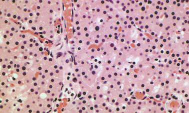 Fig. 65.5, Parathyroid oncocytic adenoma composed of large cells with abundant eosinophilic cytoplasm.