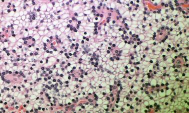 Fig. 65.6, Parathyroid water-clear cell adenoma composed of cells with multiple cytoplasmic vacuoles.