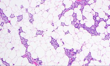 Fig. 65.7, Parathyroid lipoadenoma characterized by proliferation of both parenchymal and stromal elements.