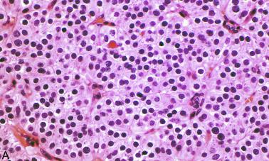 Fig. 65.9, Parafibromin-deficient parathyroid neoplasm (A) composed of cells with eosinophilic cytoplasm, enlarged nuclei, and perinuclear cytoplasmic clearing. B, Loss of nuclear expression of parafibromin by immunohistochemistry.