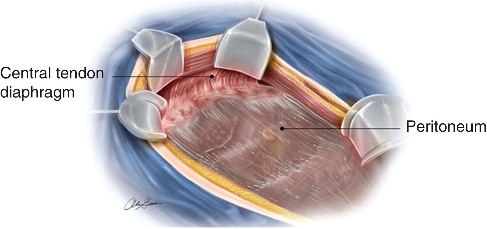 Fig. 39.1, The anterior parietal peritoneum is shown after having been stripped from the anterior abdominal wall.