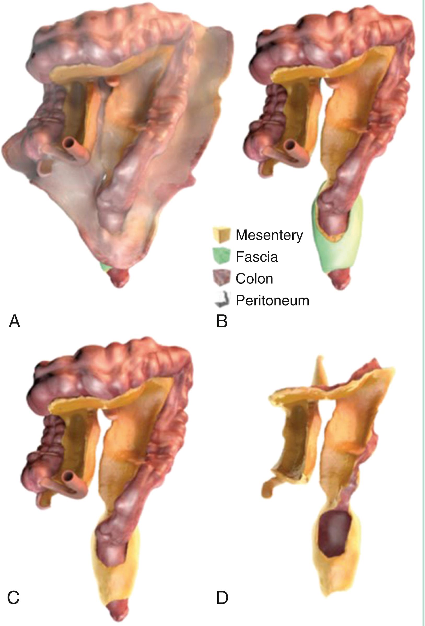 Fig. 39.2, Digital representations of peritoneum, mesentery, fascia, and intestine. A , Peritoneum, mesentery, fascia, and intestine. B , Mesentery, fascia, and intestine. C , Mesentery and intestine. D , Mesentery.