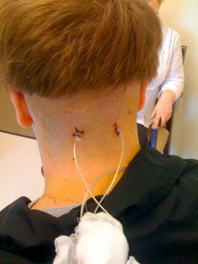 Figure 39.1, Temporary externalized electrodes affixed to the skin aimed transversely to the opposite side.