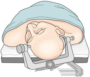 Figure 6.1, A patient is positioned supine with the head secured in space with a three-point holder.