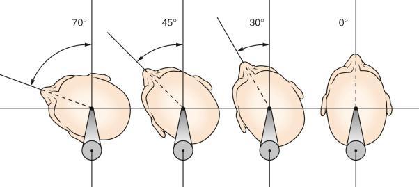 Figure 6.2, The angles of head rotation in the axial plane and its effect.