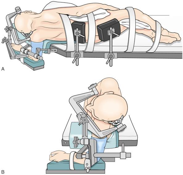 Figure 6.6, The lateral position with the arm resting on an arm sling. (A) Dorsal view. (B) Cranial view.