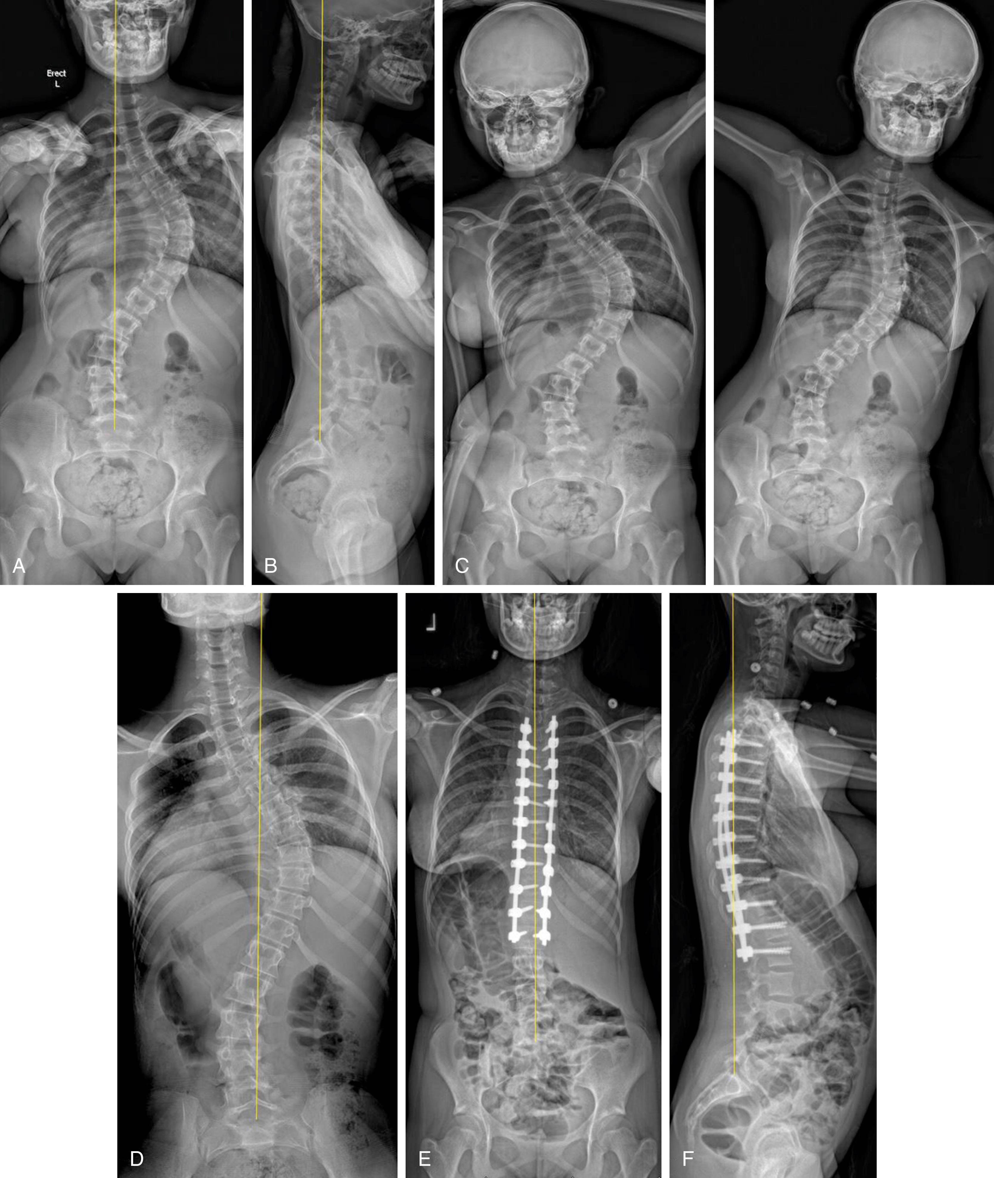 Fig. 141.1, A 13-year-old postmenarchal female presenting with adolescent idiopathic scoliosis. A, Anteroposterior (AP) radiograph preoperatively shows a right-sided main thoracic curve of 70 degrees and a thoracolumbar curve of 43 degrees. Rotation at the apex of the main thoracic curve can be appreciated by observing the pedicles––the left pedicle is not visible from T8 to T10. A significantly higher right shoulder can be appreciated. B, Lateral radiograph shows hypokyphosis of the thoracic spine as is typical in adolescent idiopathic scoliosis, as well as thoracic rib prominence posteriorly indicating apical rotation. C, On side-bending radiographs the main thoracic curve becomes 51 degrees, and the thoracolumbar curve becomes 28 degrees, denoting a stiff main thoracic curve and flexibility in the thoracolumbar curve. D, Supine imaging provides additional information on curve flexibility, as the main thoracic curve becomes 59 degrees and the thoracolumbar curve becomes 40 degrees. E, Following posterior instrumentation and fusion from T3‒L2 and periapical posterior column osteotomies at T5‒T6, T6‒T7, T7‒T8, T8‒T9, T9‒T10, and T10‒T11 to increase flexibility, the postoperative AP radiograph shows excellent coronal curve correction––this can also be appreciated by the symmetric interrib distance on the main thoracic concavity vs. preoperatively. Restoration of shoulder balance can also be appreciated. F, Postoperative lateral radiograph shows increased thoracic kyphosis. Additionally, there is near-complete overlap of bilateral rods, and the thoracic rib prominence is no longer visible, indicating significant derotation through the main thoracic apex.