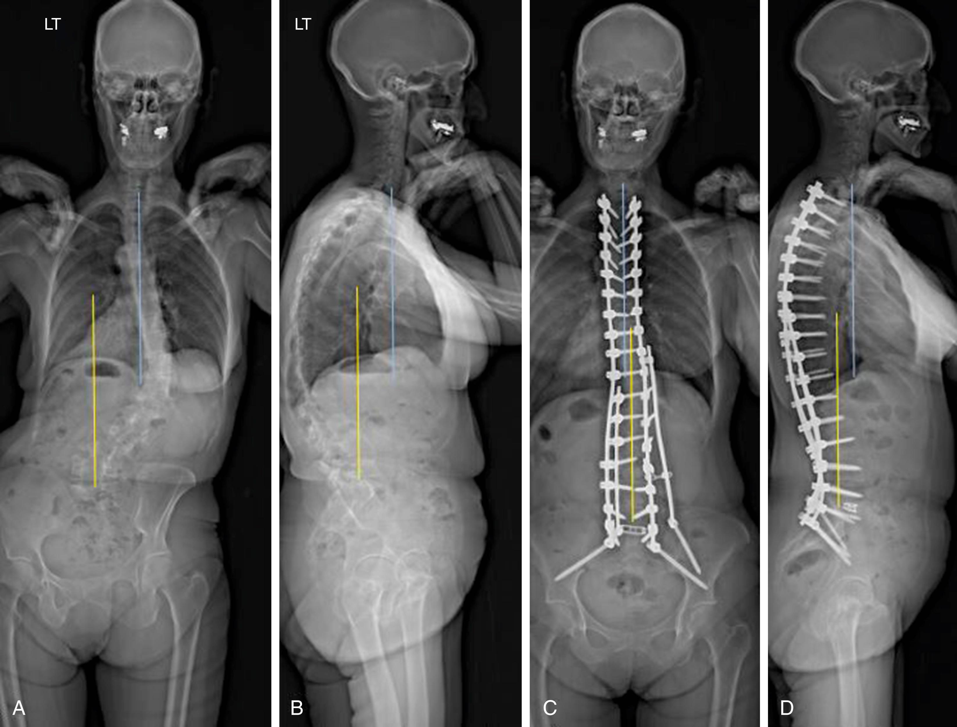 Fig. 141.2, A 63-year-old female presenting with degenerative scoliotic deformity. A, Anteroposterior (AP) radiograph preoperatively shows significant coronal imbalance, as indicated by the distance between the yellow line (central sacral vertical line) and the blue line (C7 plumb line). B, Lateral radiograph preoperatively shows significant thoracolumbar kyphosis and an increased sagittal vertical angle (SVA), as indicated by the distance between the yellow line (posterior sagittal vertical line) and the blue line (C7 plumb line). C, AP radiograph postoperatively shows major improvement in coronal balance following multilevel posterior column osteotomies from T10 to L5, a posterior fusion and instrumentation from T2 to pelvis using S2-alar-iliac screw screws, and a transforaminal interbody lumbar fusion at L5‒S1. A kickstand rod on the side of the trunk shift provided additional coronal plane correction. D, Lateral radiograph postoperatively shows restoration of lumbar lordosis and thoracic kyphosis, with a corresponding decrease in SVA.