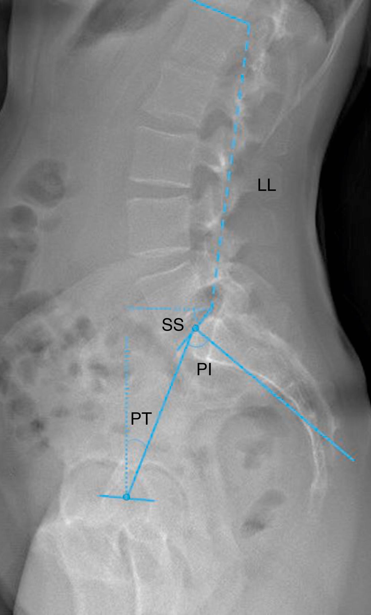 Fig. 141.3, Measurements in spinopelvic alignment. Lumbar lordosis ( LL ) is measured between the cephalad end plate of L1 and the S1 end plate. Sacral slope ( SS ) is measured as the angle between the S1 end plate and the horizontal plane. Pelvic tilt ( PT ) is measured as the angle between the midpoint of the S1 end plate to the bicoxofemoral axis and the vertical axis. Pelvic incidence ( PI ) represents the position of the sacrum relative to the femoral heads and is measured as the angle between a line perpendicular to the S1 end plate and a line to the bicoxofemoral axis. PI is the sum of the SS and PT.