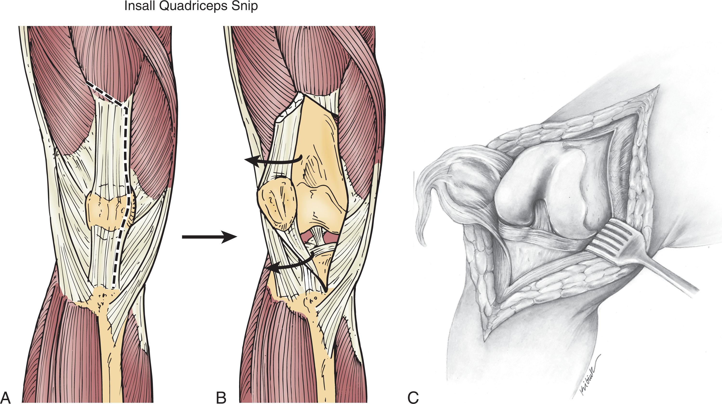 Fig. 7.5, (A) Coonse-Adams lateral quadriceps turndown technique. Diagrammatic relationship between main medial capsulotomy and proximal lateral oblique incision (Springer in Surgical Techniques in Total Knee Arthroplasty pp. 149–154). (B) Anteromedial capsulotomy is shown with minimal dissection necessary to achieve proximal lateral incision. (C) Exposure present after performing proximal lateral turndown. (A) (From Garvin, KL, Aberle, NS. Quadriceps Snip Techniques in Revision Hip and Knee Arthroplasty. 2015; 40–44.)