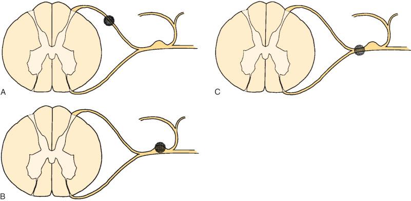 FIG. 112.1, Rhizotomy and ganglionectomy. The circular shaded areas the surgical lesions for (A) intradural rhizotomy, predominantly for use in cervical and thoracic areas; (B) extradural rhizotomy, predominantly used in the lumbosacral region; and (C) ganglionectomy.