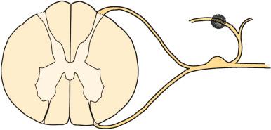 FIG. 112.2, Facet rhizotomy. The circular shaded area represents the surgical lesion created.