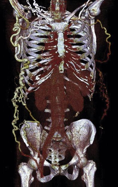 Figure 55-2, CT angiogram of a patient with SVC syndrome. Axillary and chest wall venous collaterals are present as a consequence of extensive central venous occlusion.