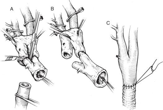 FIG 20.2, My preference for anastomosing the graft to the carotid bifurcation is an eversion endarterectomy followed by an end-to-end anastomosis. (A) Eversion of the external carotid after exposing the flow divider in the plaque. (B) Eversion of the internal carotid component of the plaque. (C) Anastomosis of the graft to everted bifurcation.