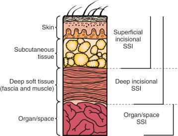 Fig. 77.1, Cross-section of the abdominal wall. Wounds are classified as superficial incisional, deep incisional, and organ/space infections. SSI, Surgical site infection.