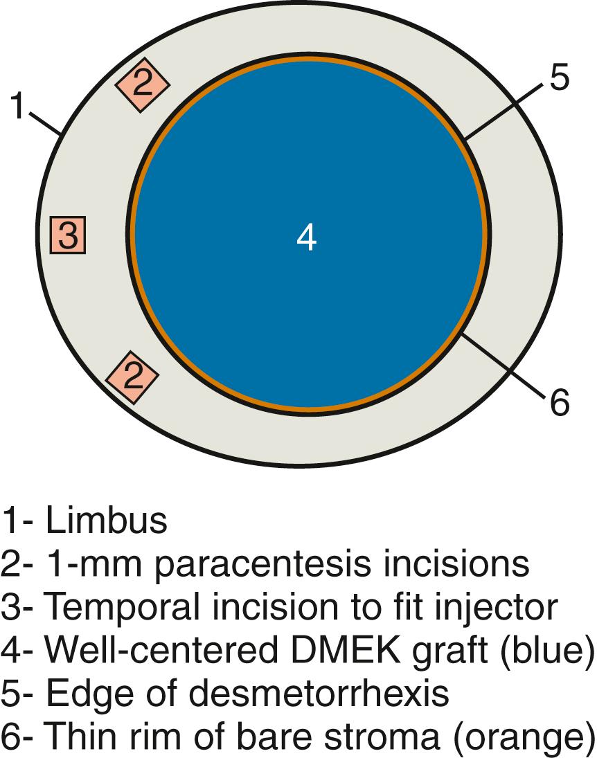 Fig. 135.2, Host preparation for Descemet membrane endothelial keratoplasty (DMEK). Note the absence of overlap of graft and the host Descemet membrane.