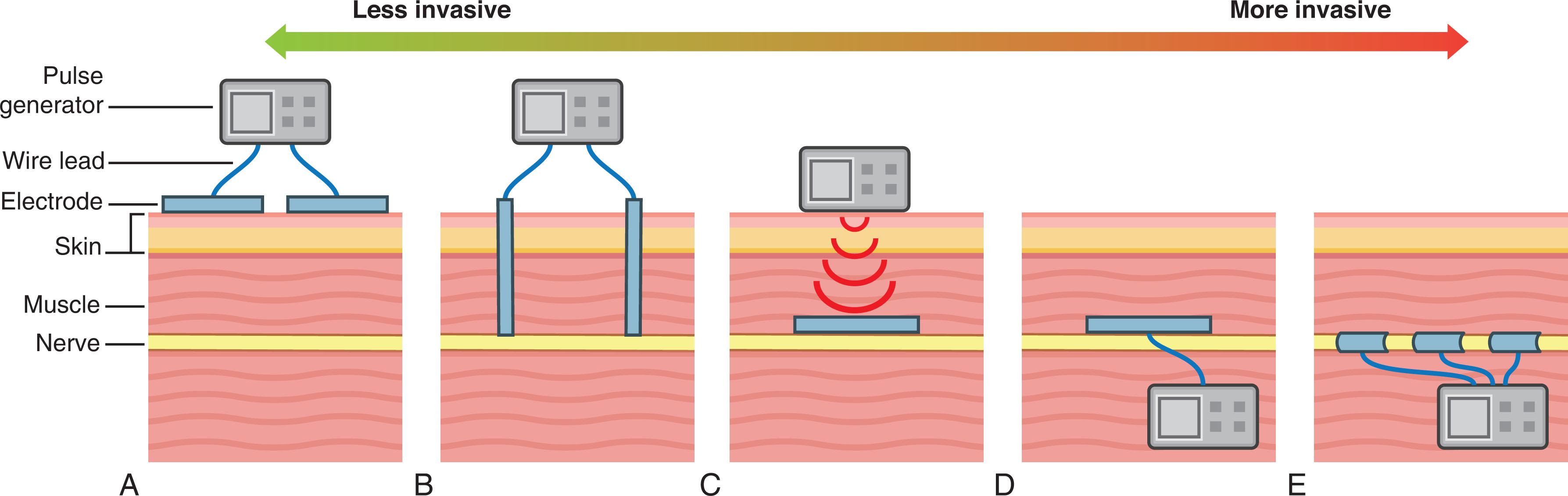 Figure 5.1, A , Simplified skin diagram showing layers of skin, muscle, and nerve. Peripheral nerve stimulation configurations include transcutaneous ( B ), percutaneous electrodes with external wired generator ( C ), fully implanted electrode/receiver with external pulse generator ( D ), fully implantable perineural electrode with implanted pulse generator ( E ), and multiple implanted cuff electrodes with implanted pulse generator ( F ).