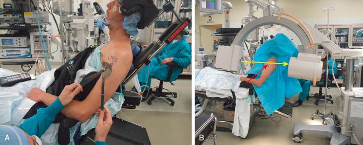 Fig. 14A.1, A, The patient is placed in the beach-chair position on the operating room table. B, The image intensifier is brought over the top of the patient and draped into the surgical field. The orientation of the image intensifier relative to the torso gives the equivalent of a 45-degree cephalic tilt view of the clavicle.