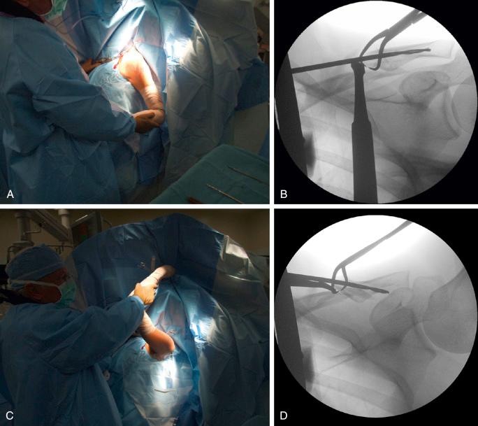 Fig. 14A.2, A, Extending the arm of the patient gives the equivalent of an anteroposterior view. B, C-arm image. Note the position of the drill bit relative to the equator of the clavicle. C, Forward flexing the arm gives the equivalent of a “near axillary” view. D, C-arm image. Note the exit point of the drill bit halfway between the conoid tubercle and the acromioclavicular joint.
