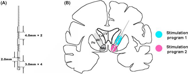 Figure 90.1, Electrode and stimulation program setting. The SceneRay 1242 electrode was designed to have a diameter of 1.27 mm and 4 contacts. The contact length is 3.0 mm and the spacing between the ventral and dorsal contacts is 2, 4, and 4 mm, with a total length of 22.5 mm (3+2+3+4+3+4+3 and 0.5 projecting from the electrode tip). The electrodes were designed to enable independently programmed stimulation after implantation, spanning from the anterior limb of the internal capsule (ALIC) to the nucleus accumbens (NAc), with two ventral contacts located within the ventral NAc and two dorsal contacts located within the ALIC. Copied from Lei Chen's doctorial thesis with permission, Novel deep brain stimulation in ventral striatum/ventral capsule to treat opioid addiction (in Chinese).