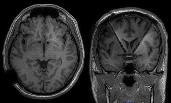 Figure 90.2, Ventral capsule/ventral striatum deep brain stimulation magnetic resonance imaging.