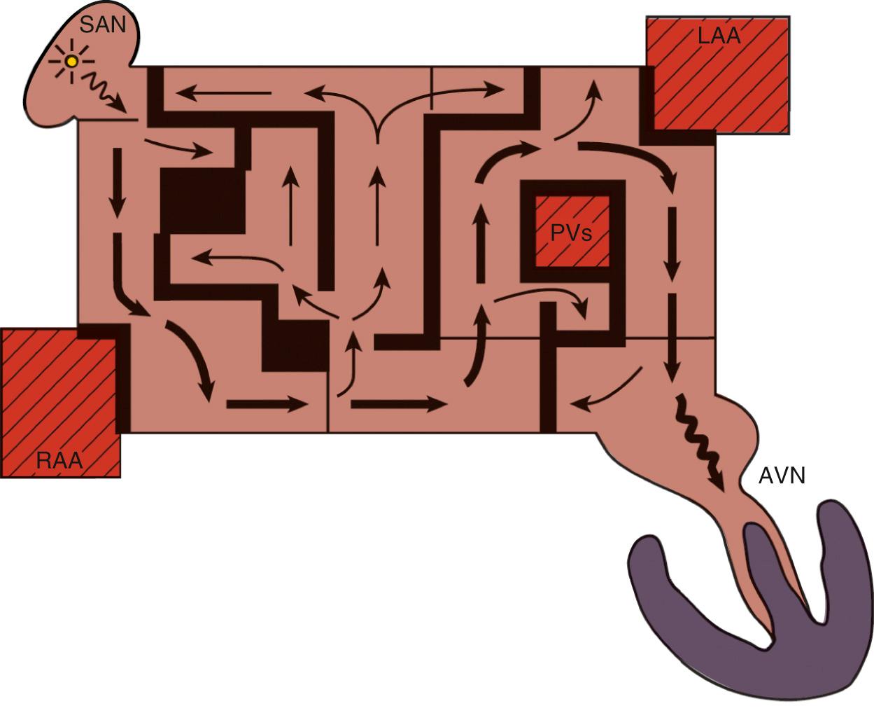 FIGURE 87-1, Original conceptual design of the Cox-Maze procedure for atrial fibrillation. Both atrial appendages were excised, and the pulmonary veins were isolated. AVN, Atrioventricular node; LAA, left atrial appendage; PVs, pulmonary veins; RAA, right atrial appendage; SAN, sinoatrial node.