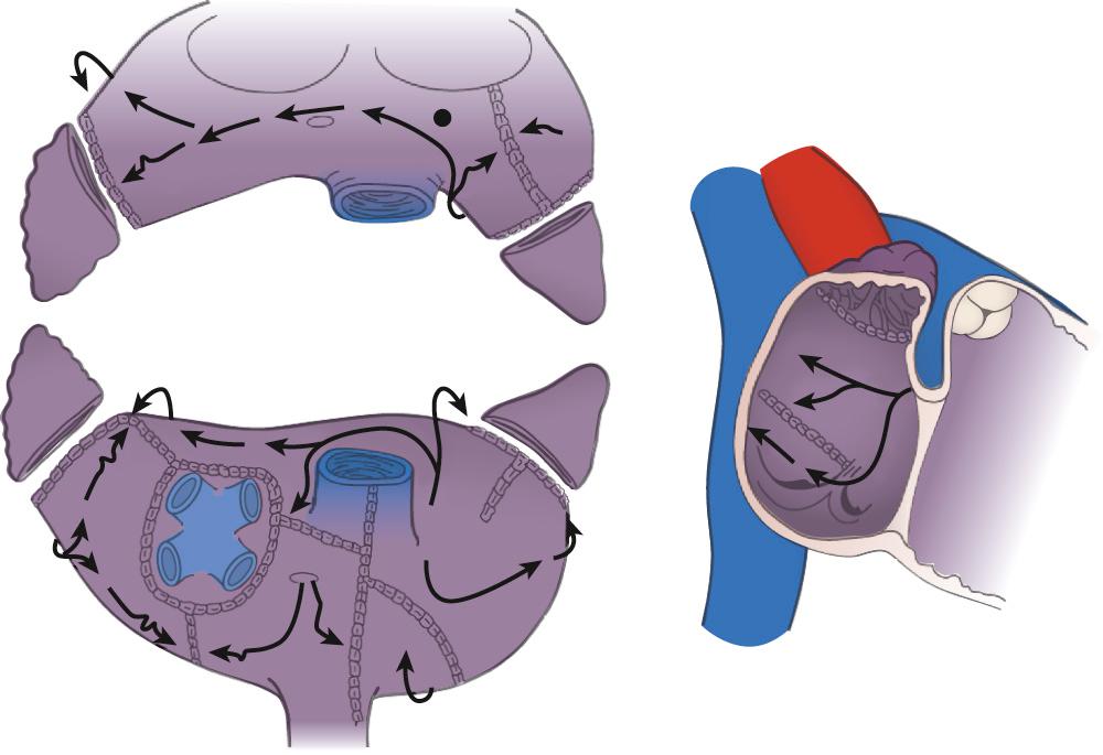 FIGURE 87-2, Two-dimensional drawing depicting the atrial incisions of the Cox-Maze III procedure.