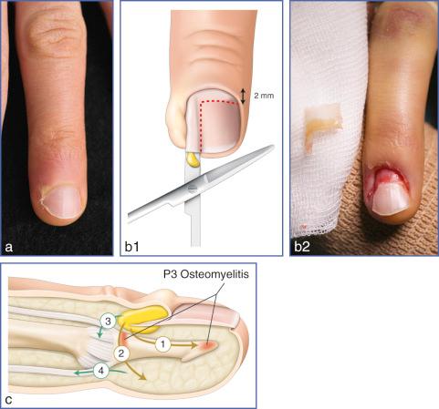 Fig. 19.1, (a) Acute paronychia. (b1, b2) The nail plate is elevated by the presence of pus and it should be excised. (c) A paronychia may progress to involve the distal phalanx (1), DIP joint (2), tendons (3, 4) and the pulp.