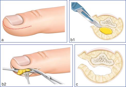 Fig. 19.2, Felon causes compartment syndrome of the pulp to occur. A fish-mouth incision (a) was used to excise and debride underlying necrotic tissue (b1,b2). An adequate debridement should be performed to prevent spread of infection (c).