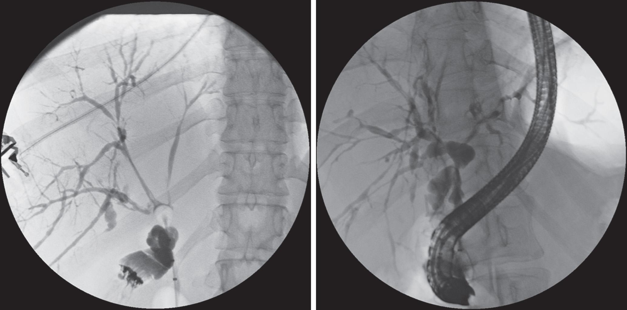 FIGURE 117.1, Endoscopic retrograde cholangiopancreatographic images depicting typical cholangiographic findings of primary sclerosing cholangitis.