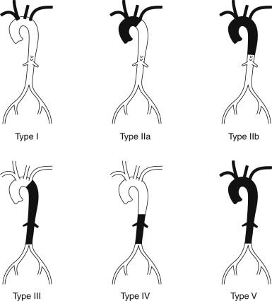 FIGURE 1, Tokyo International Conference Classification of Takayasu arteritis, based on initial angiographic findings.