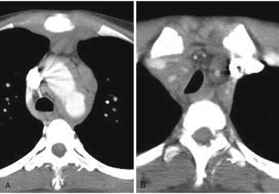 FIGURE 2, A, Computed tomography angiography (CTA) demonstrating thickening of the wall of the aortic arch. B, CTA demonstrating wall thickening and luminal narrowing of all the arch vessels.