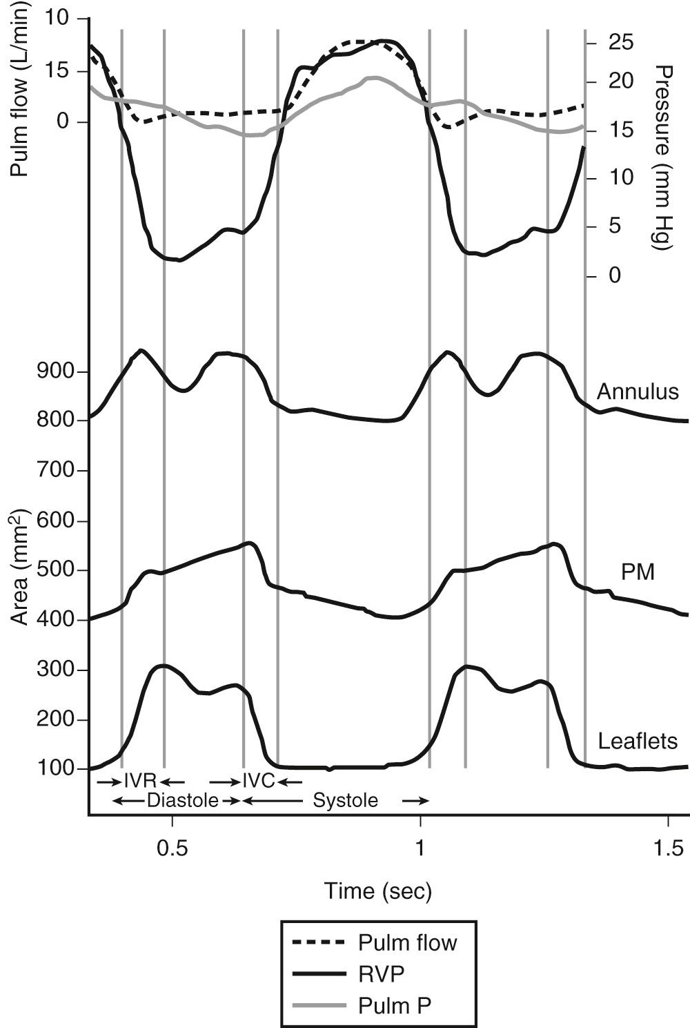 FIGURE 81-1, Changes in the normal tricuspid valve during the cardiac cycle. Top, Pressure curves of blood flow in the pulmonary artery (Pulm flow), the right ventricle (RVP), and the pulmonary artery (Pulm P). Bottom, Changes in the areas delineated by the ultrasound transducers placed around the tricuspid annulus (Annulus), the tips of the three papillary muscles (PM), and the free edges of the three leaflets (Leaflets) during two cardiac cycles. These recordings allowed the cardiac cycle to be split into diastole, systole, isovolumic contraction (IVC), and isovolumic relaxation (IVR).
